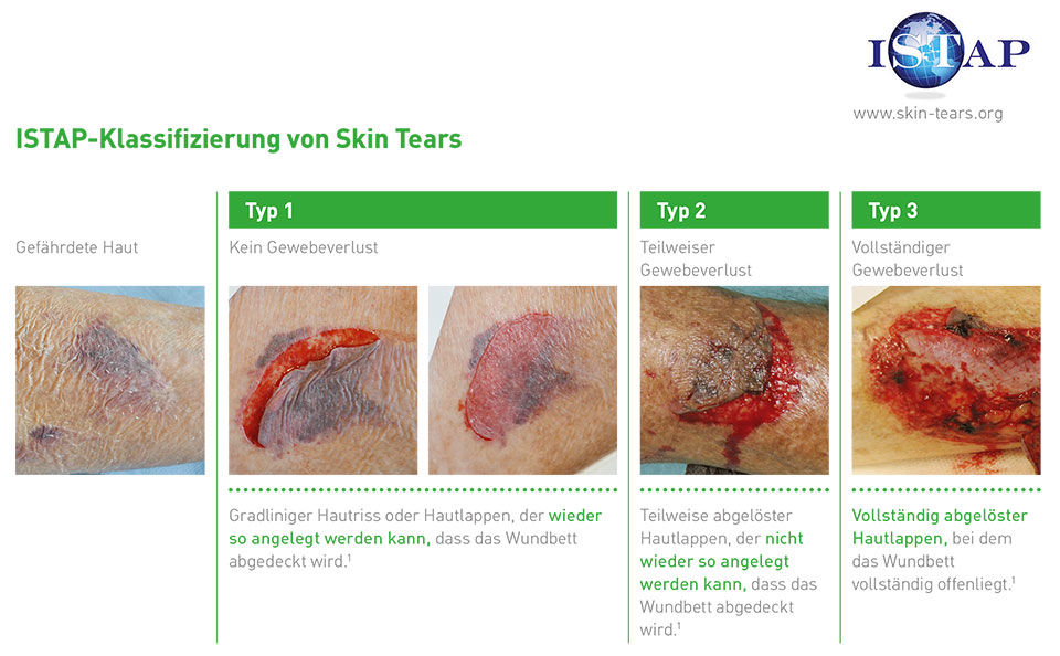 ISTAP Klassifizierung von Skin Tears