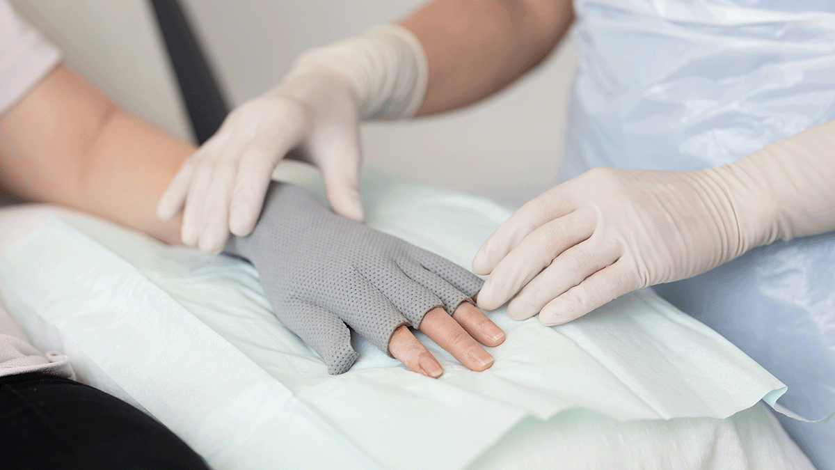 A photo of a hand with a burn dressing. 