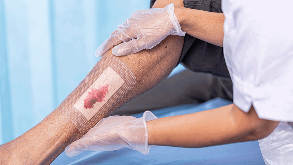 A photo of a leg wound with a dressing, the hands of a nurse is holding the leg. 