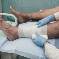 Venous leg ulcer management 