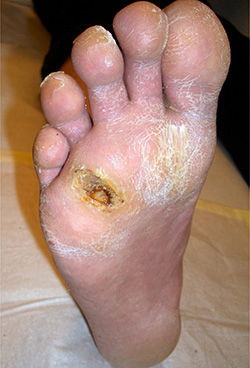 Abb 1 Neuropathie