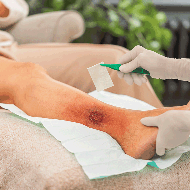 A photo of hands applying Exufiber Effect onto a leg ulcer. 